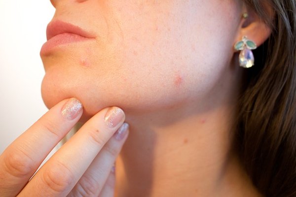 Comment utilise-t-on les huiles essentielles pour traiter les boutons de fièvre ?