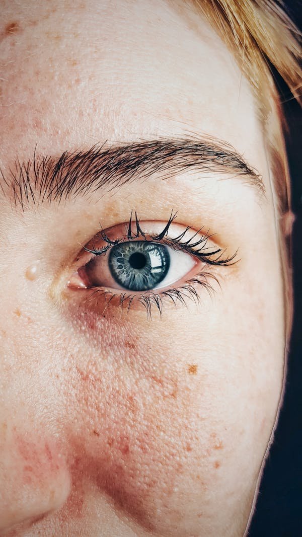 Rajeunissement des yeux : explorez la blépharoplastie inférieure